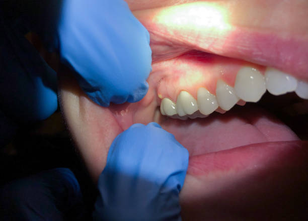 Best Emergency Tooth Extraction in West Monroe, MI