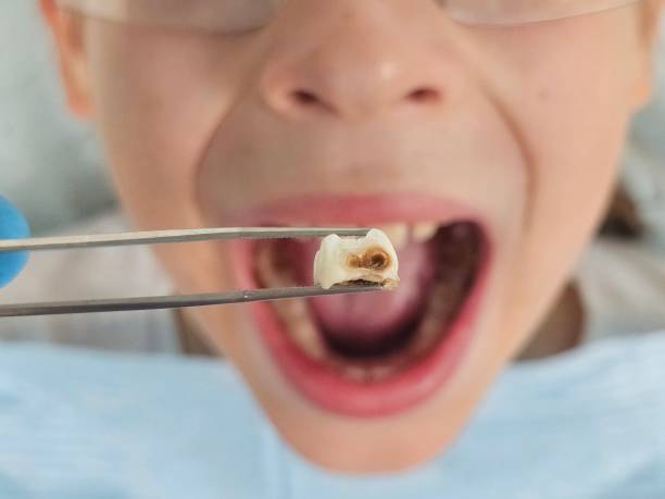 Best Urgent Care for Lost Fillings or Crowns in West Monroe, MI